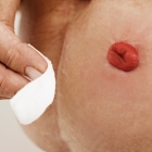 Odstránenie ochlpenia okolo stómie