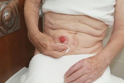 Je velmi důležité, aby bylo okolí stomie před nasazením sáčku úplně suché.