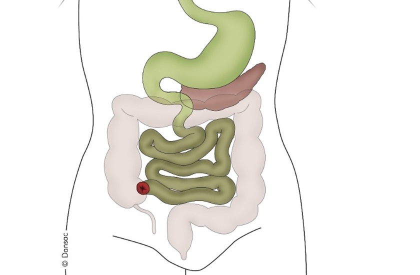 Ileostomie