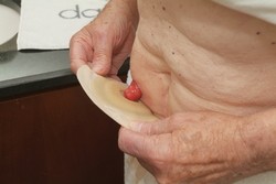 Sáček začněte nalepovat od dolní poloviny a těsně pod stomií.