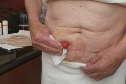 Osušte čistou a suchou gázou. Je velmi důležité, aby bylo okolí stomie před nasazením podložky úplně suché.