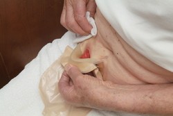 Pomocí jedné ruky napněte kůži na břiše a opatrně odstraňte podložku.