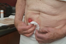 Dôkladne očistite vašu stómiu a jej okolie.