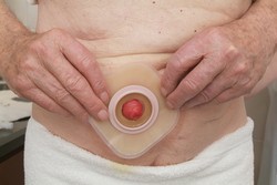 Podložku prsty přitlačte od středu stomie směrem k okrajům.