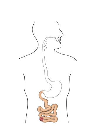 Ileostomie