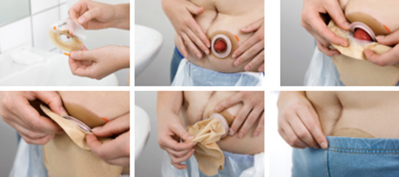 Aplikace podložky a sáčku