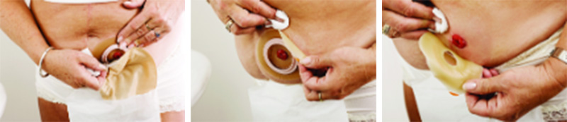 Odstranění sáčku a podložky